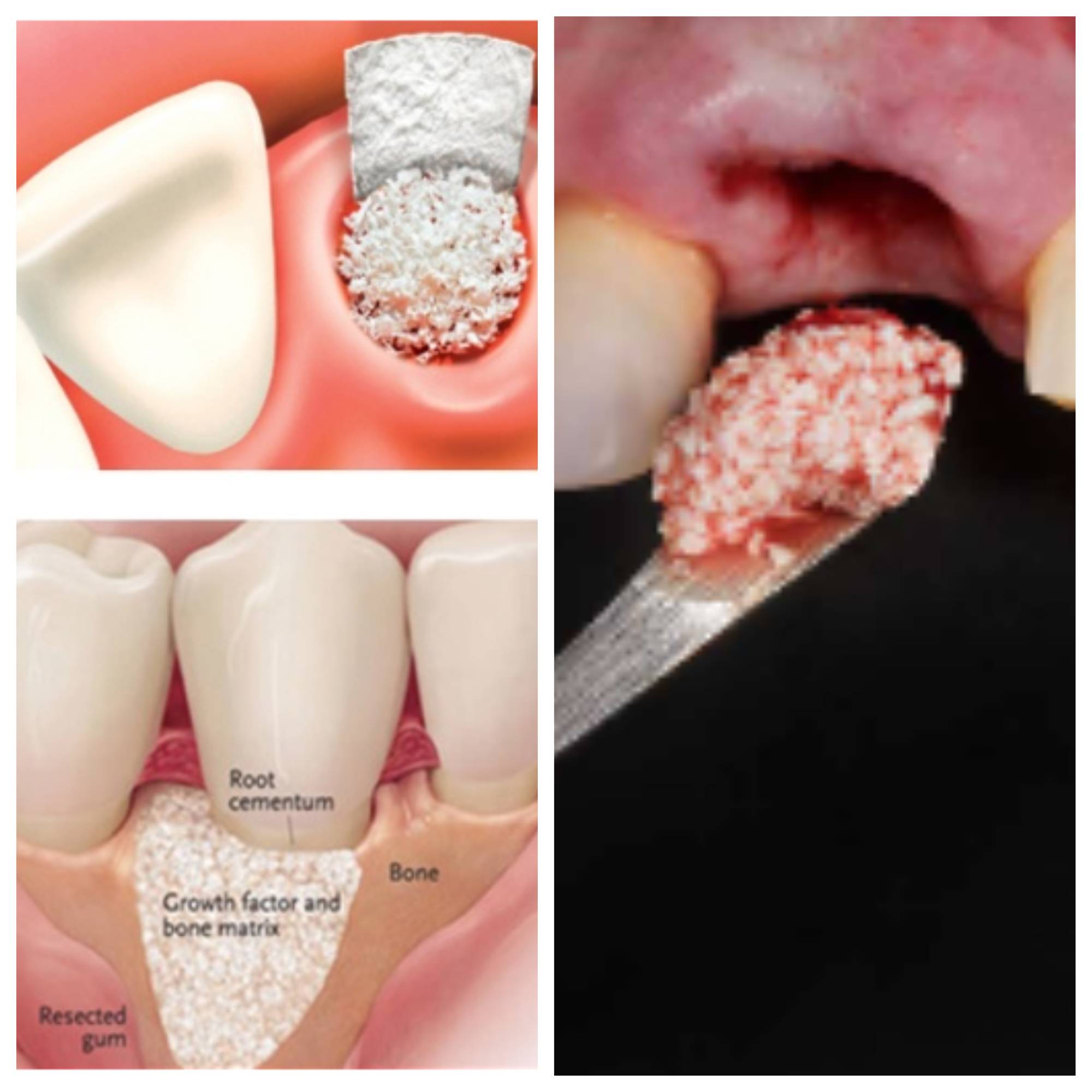 Restoring Your Smile With Dental Bone Grafting: Everything You Need To Know