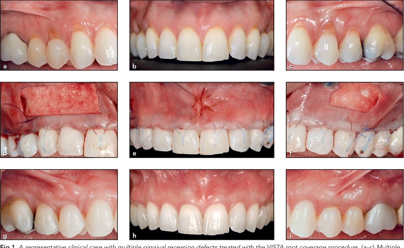 Vestibular Incision Subperiosteal Tunnel Access (VISTA)