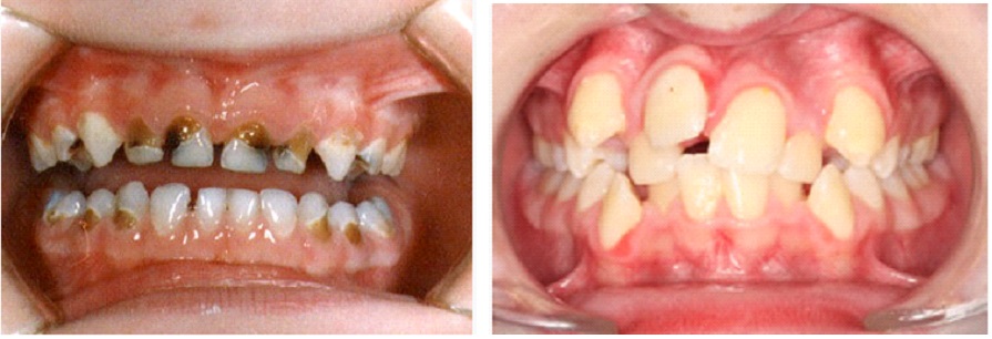 Do Primary Teeth Play A Crucial Role In The Eruption Of Permanent Dentition?