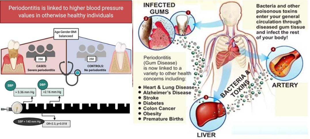 Do You Know? Poor Oral Health Is Linked To Hypertension