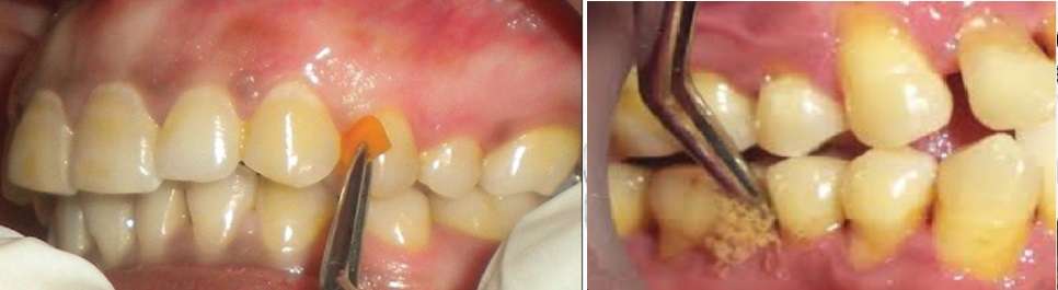 Fight Periodontal Disease With Minimally Invasive Local Drug Delivery