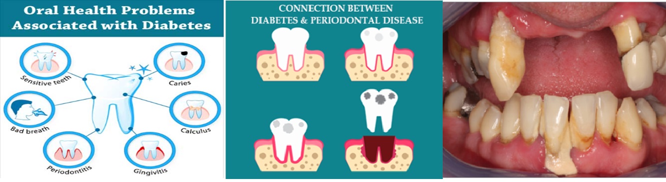 Diabetes And Dental Issues Go Hand In Hand