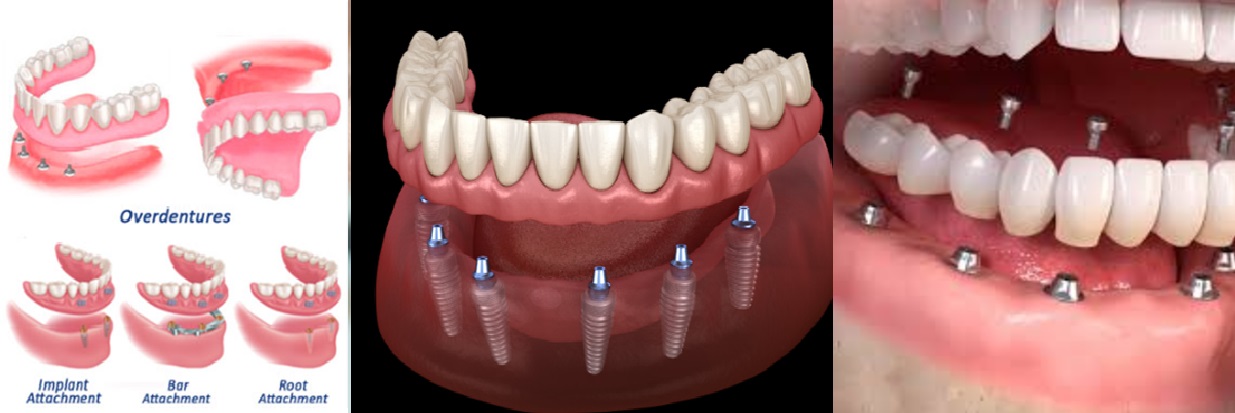 Overdenture: An Effective Solution For Edentulous Patient