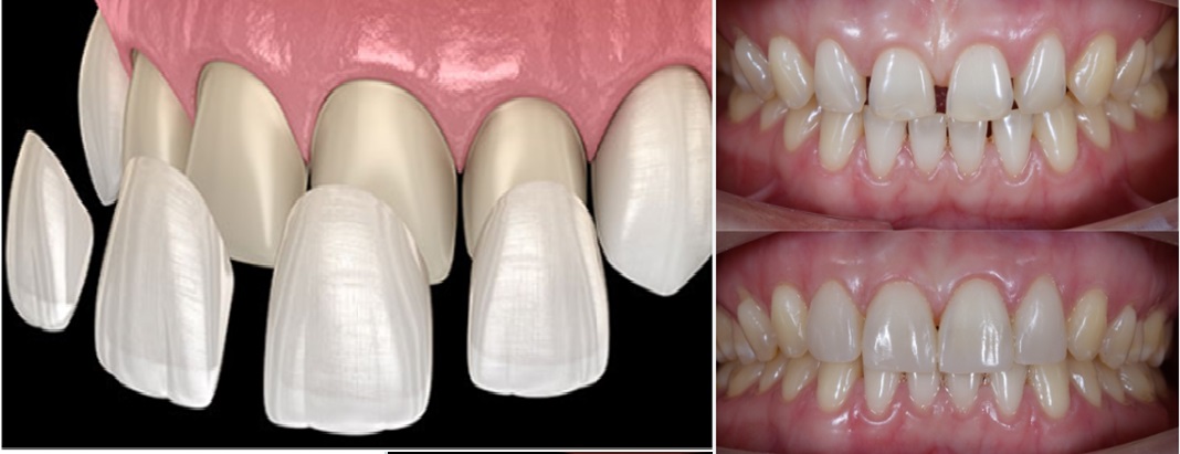 Porcelain Veneers: Transform Your Smile