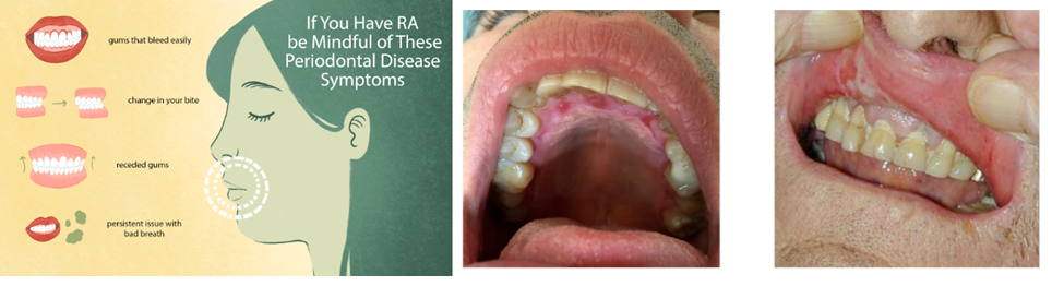 Rheumatoid Arthritis And Dental Issues: Understanding The Connection