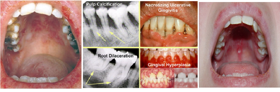 Systemic Lupus Erythematosus And Oral Health: All You Need To Know