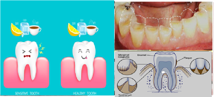 Understanding And Managing Teeth Sensitivity: Causes, Symptoms, And Treatment